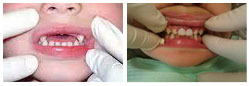 Description: http://www.32diamondsdentalclinic.com/images/services-images/kids12.jpg